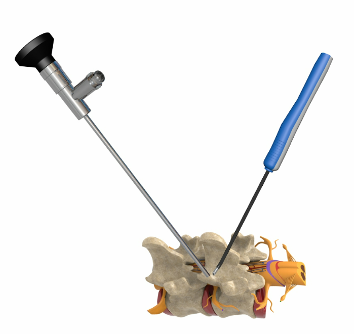 4mm 30° Dual-Port Rigid Endoscope for Spinal Surgery